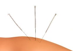 Fertility . Acupuncture needles