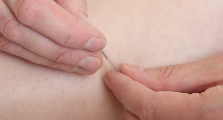 What is Acupuncture and Conditions Treated? . needling close up (my own image)